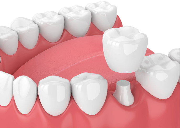 Dental Crowns in Hendersonville, North Carolina