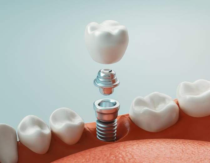 The Dental Implant Process in Hendersonville, NC