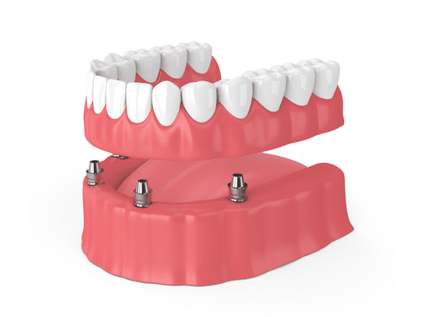 Dental Implants vs Dentures in Hendersonville, NC 
