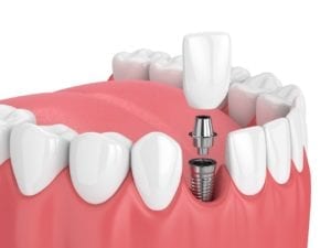 hendersonville, north carolina dental implants