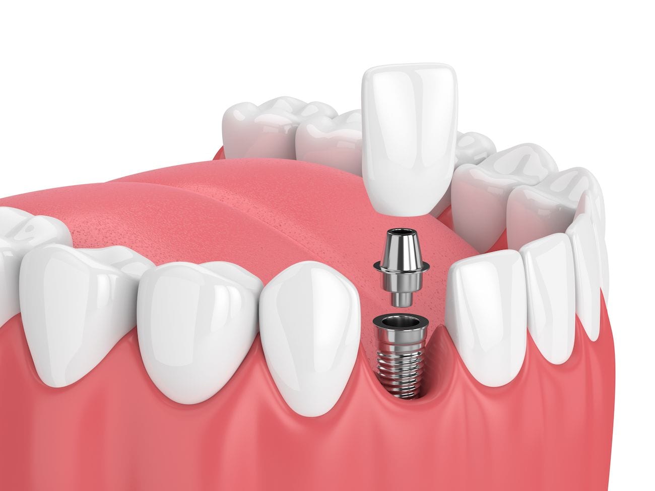 Why Choose Dental Implants? | Dentist in Hendersonville