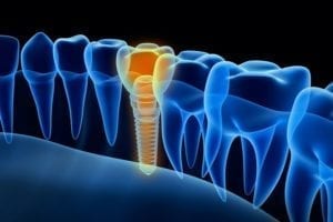 affordable dental implants in hendersonville, north carolina