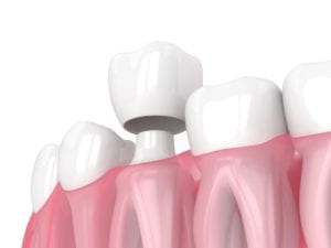 dental crown procedures in Hendersonville North Carolina