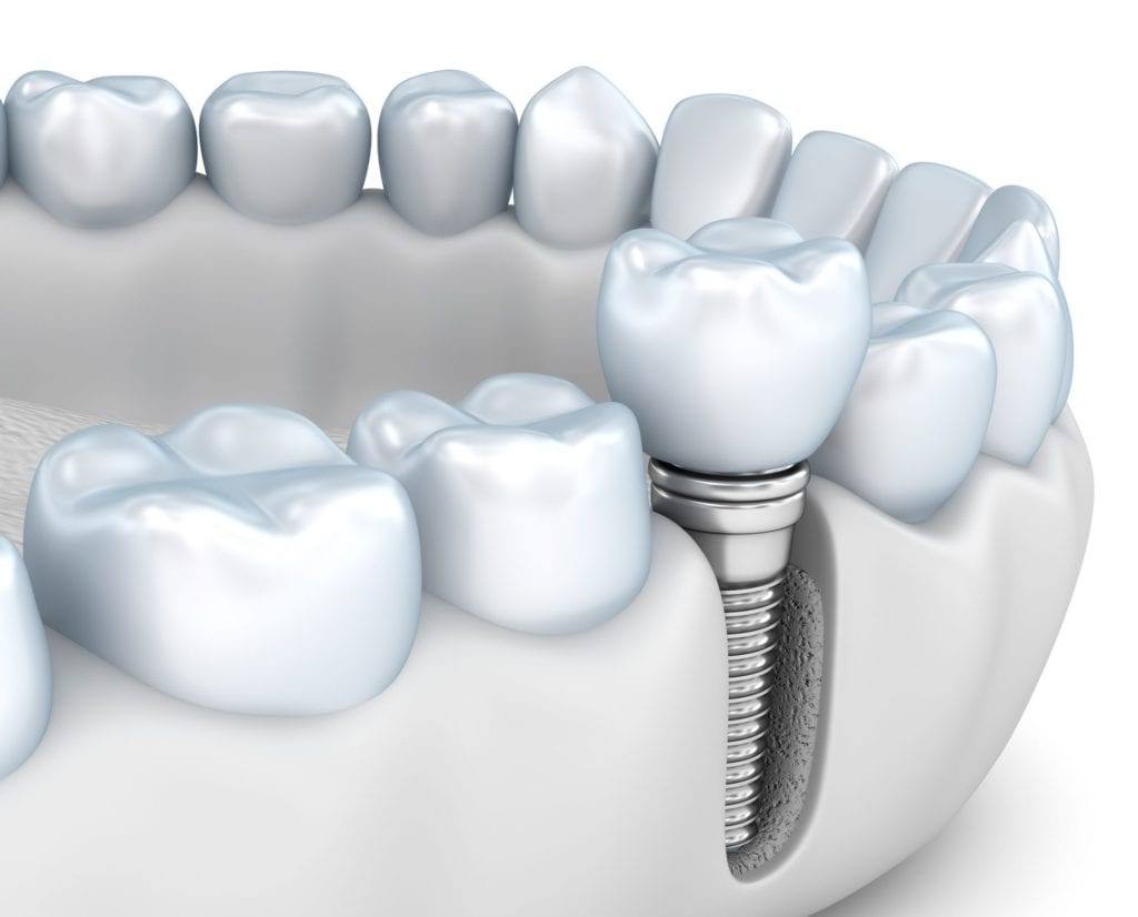 Single Dental Implant in Hendersonville North Carolina