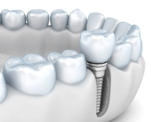 dental implants restore your smile in Hendersonville North Carolina