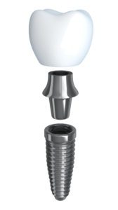 Dental Implants FAQs Hendersonville NC