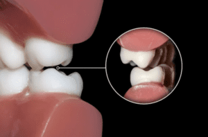 close-up image of back molars grinding bruxism teeth grinding dentist in Hendersonville North Carolina