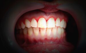 Mouth with bleeding gums on a dark background gum disease periodontal disease dentist in Hendersonville North Carolina