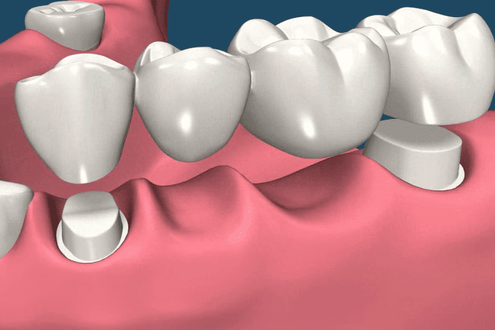 Traditional dental bridges in Hendersonville