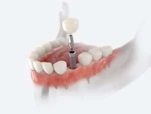 How Long Do Dental Implants Last? in Hendersonville, NC