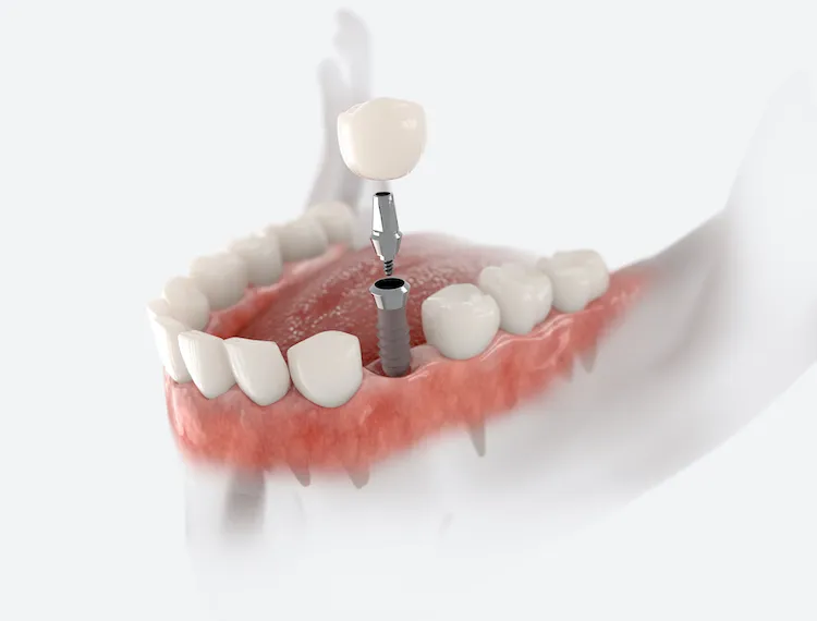 How Long Do Dental Implants Last? in Hendersonville, NC